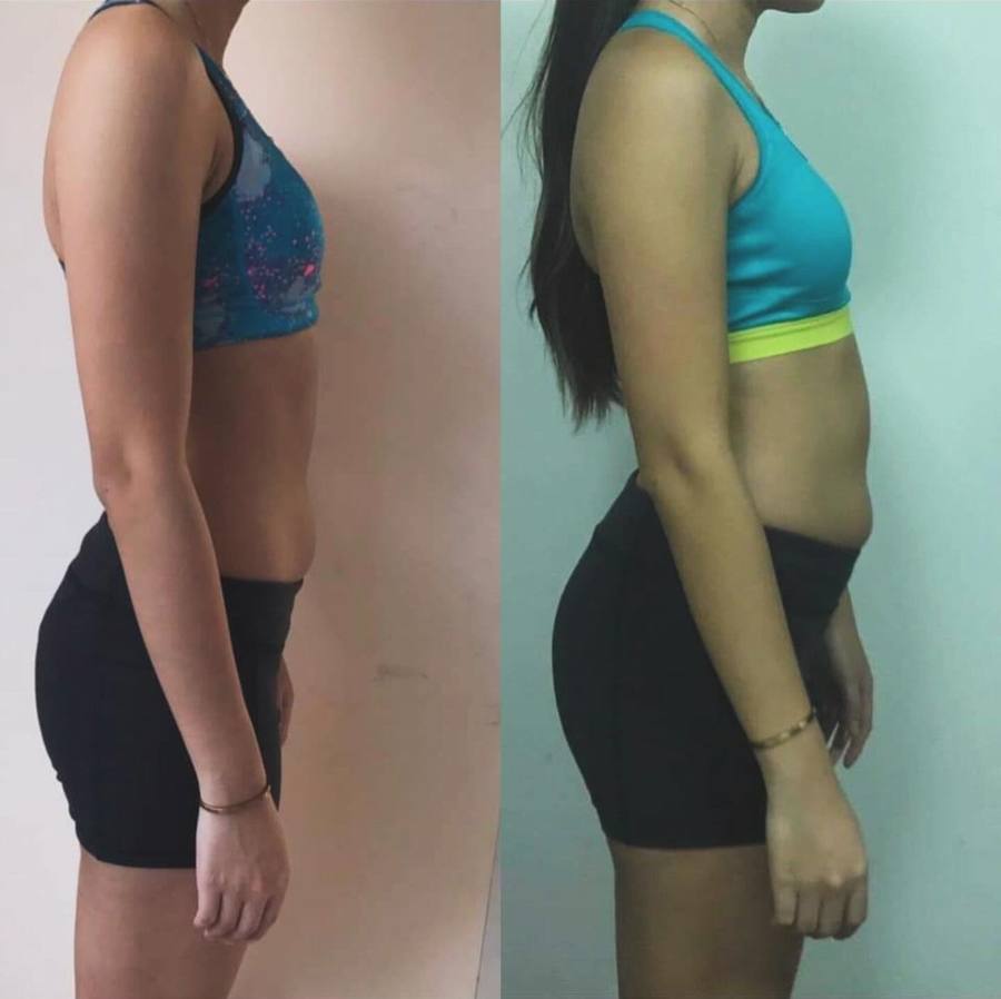 Female client before and after, side view